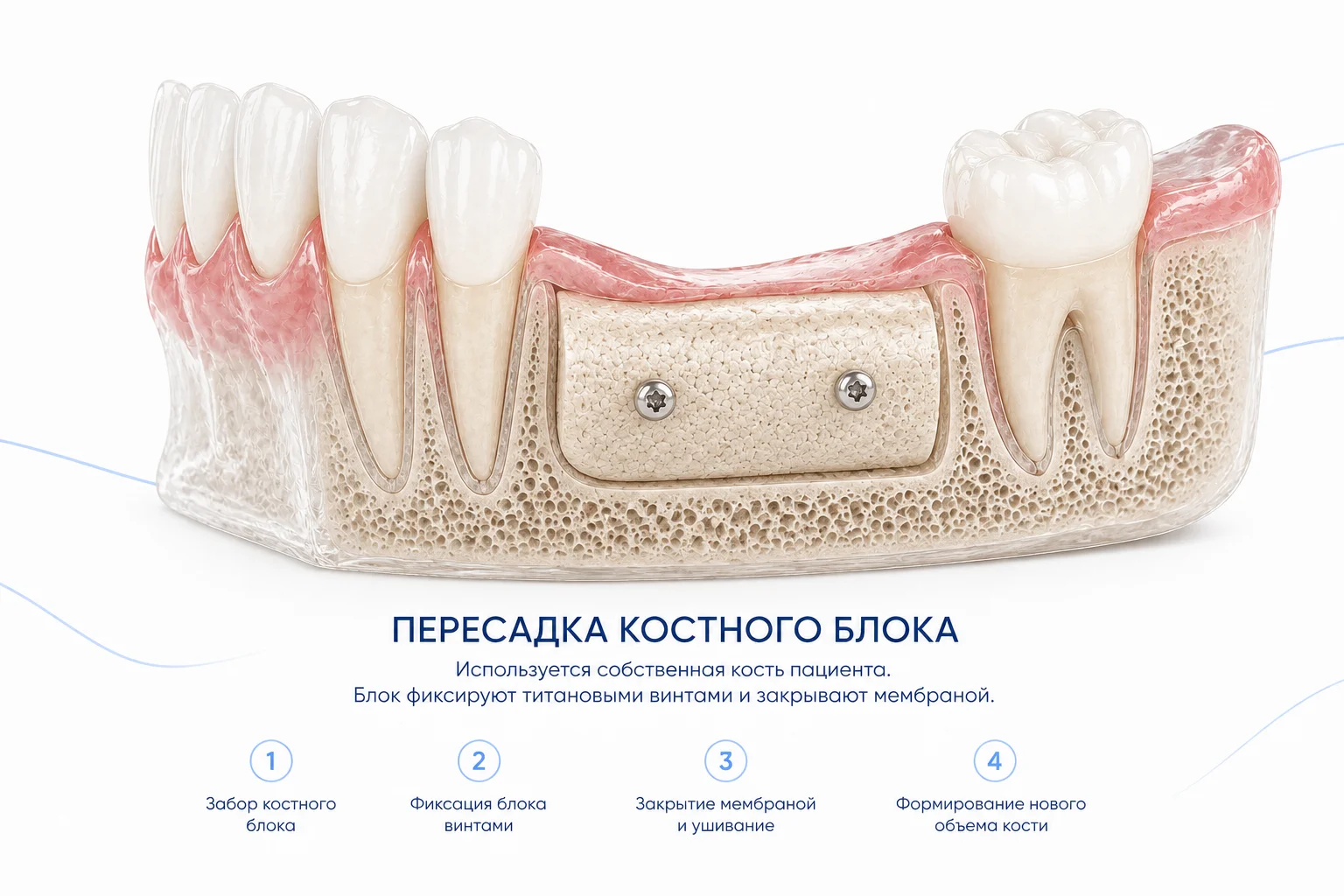 Пересадка костного блока