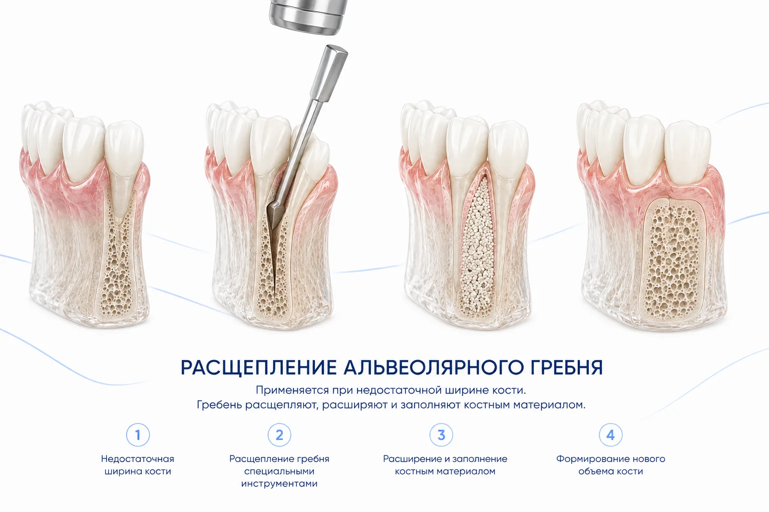 Расщепление альвеолярного гребня