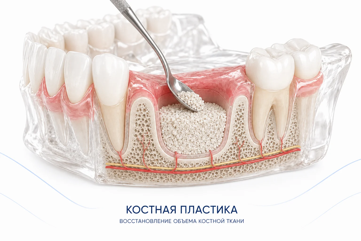 направленная костная пластика