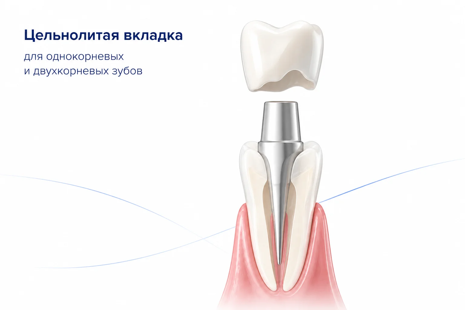 цельнолитая культевая вкладка фото