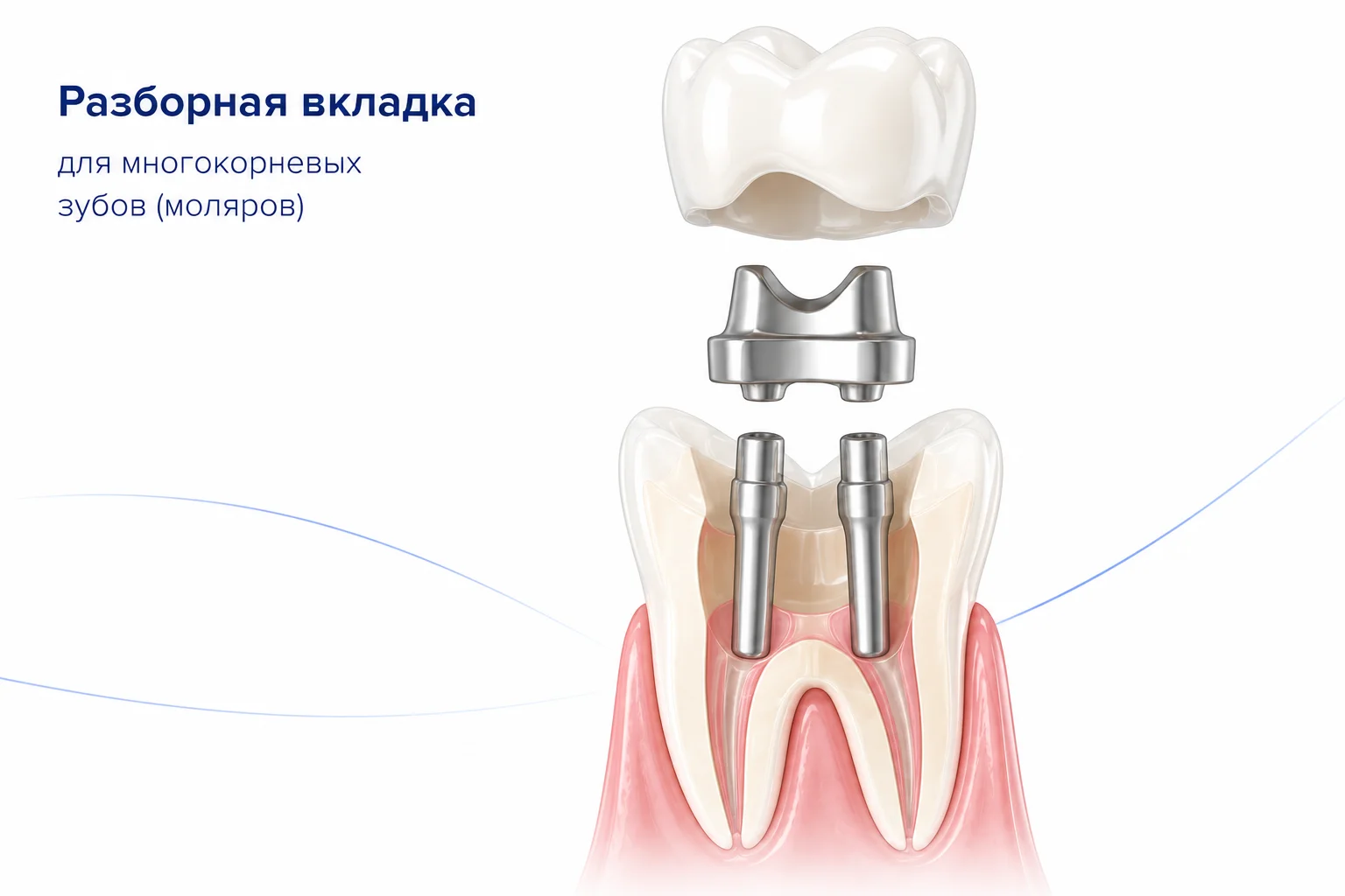 цельнолитая культевая вкладка фото