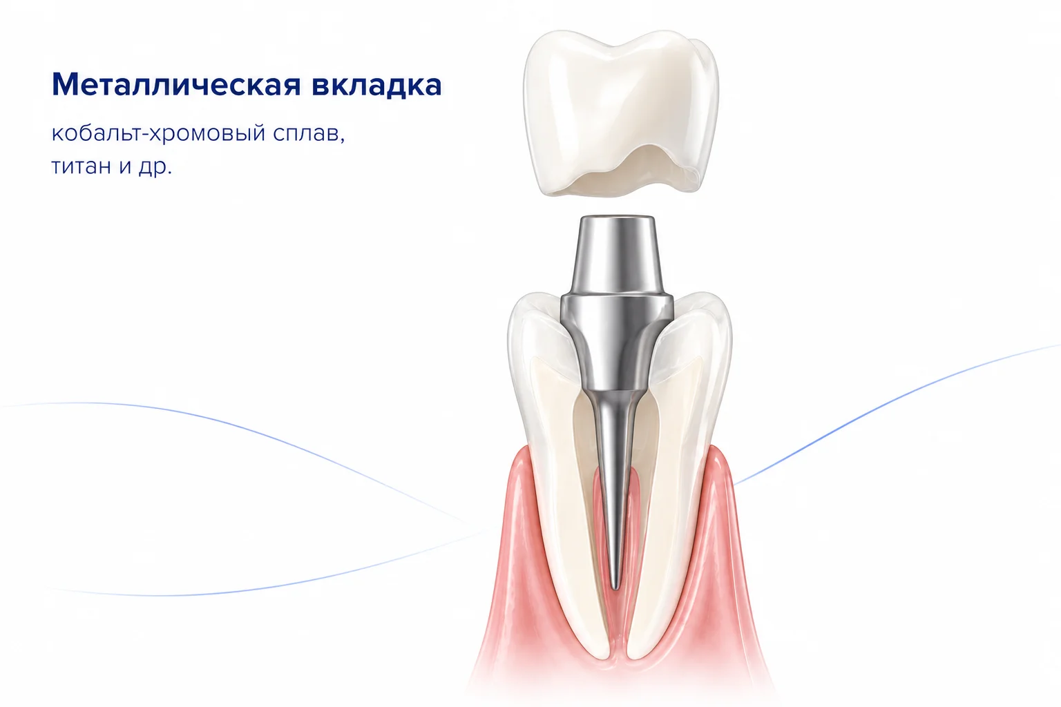 металлическая культевая вкладка фото