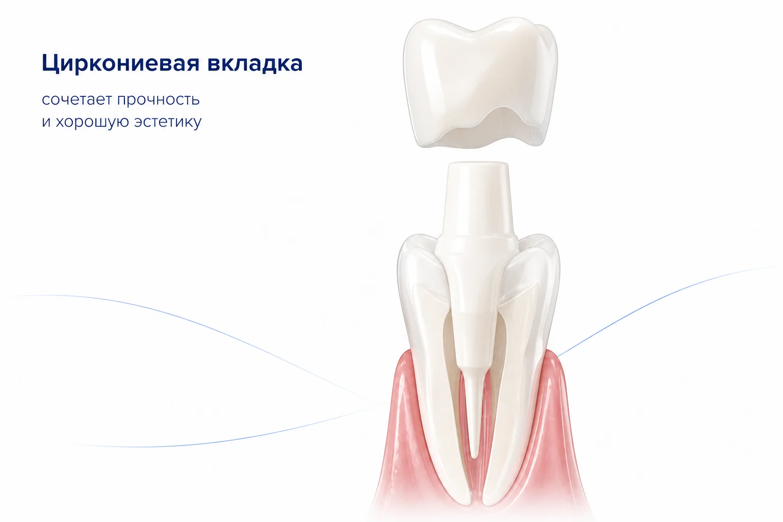 циркониевая культевая вкладка фото